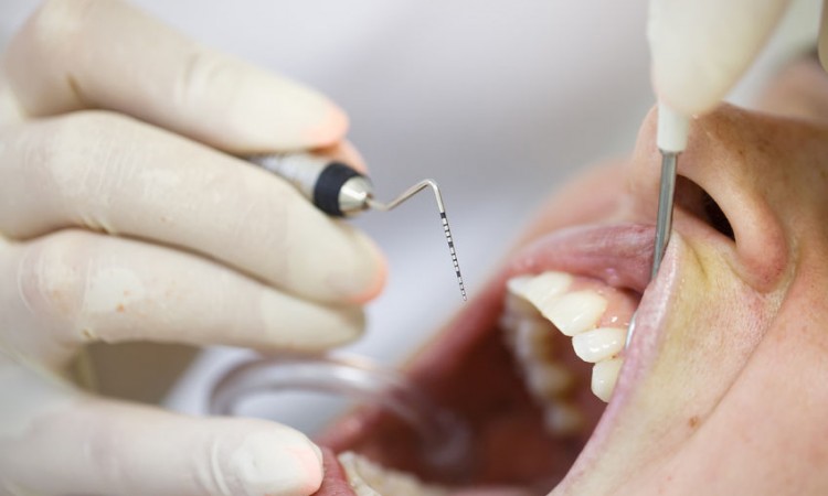 43278139 - periodontal probe, held by dental hygienist, measuring pocket depths around tooth, examining progression of periodontal disease. dental hygiene, periodontal disease and prevention concept.