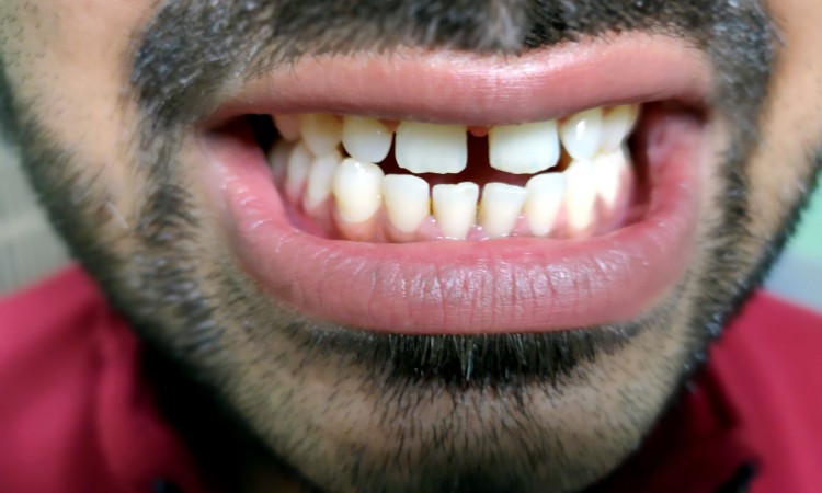 A man with a beard shows his teeth, he has a tooth gap.