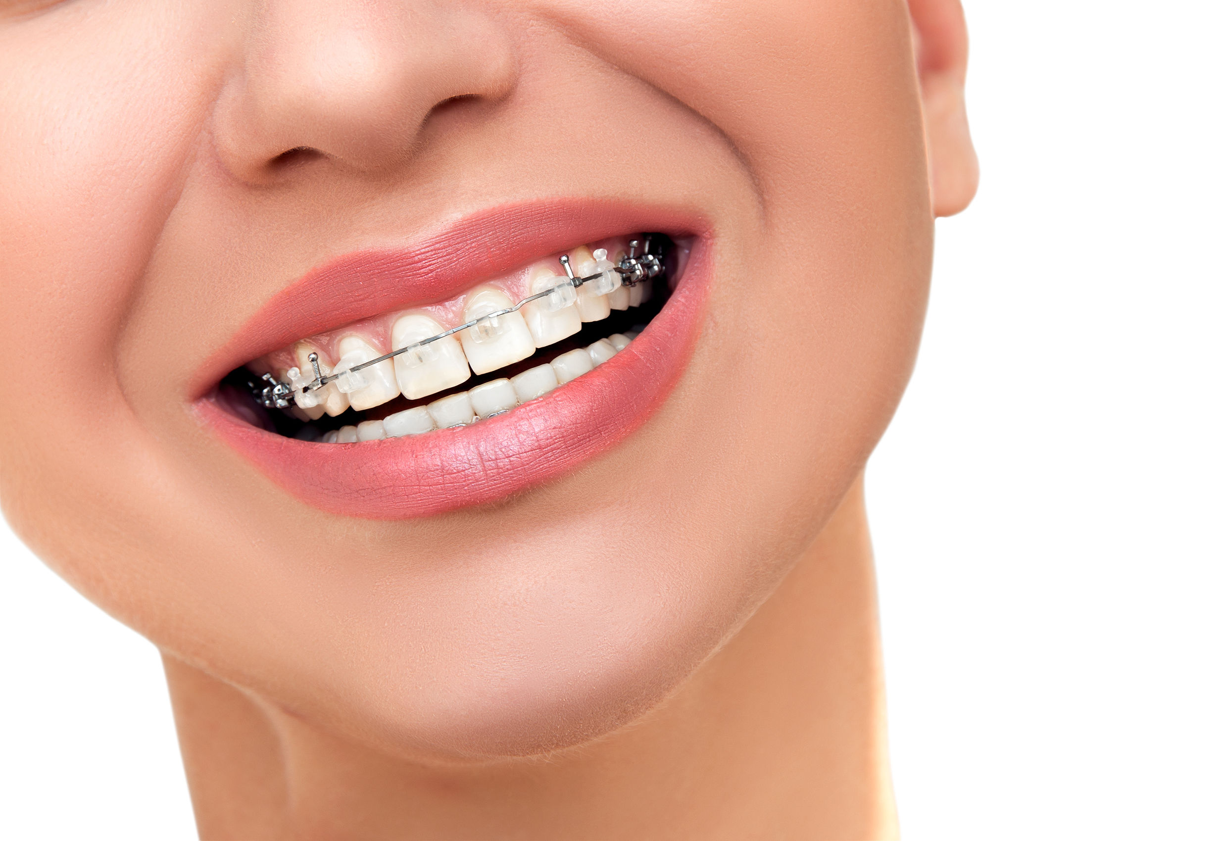Closeup Beautiful Female Smile with Transparent Ceramic and Metal Braces on Teeth. Orthodontic Treatment.