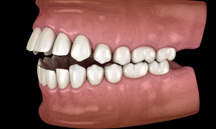 Openbite dental occlusion ( Malocclusion of teeth ). Medically accurate tooth 3D illustration