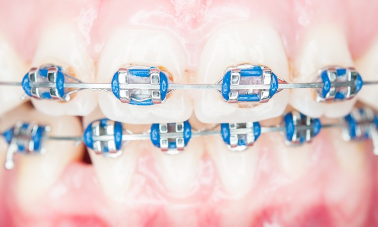 Close-up orthodontics teeth with stains.